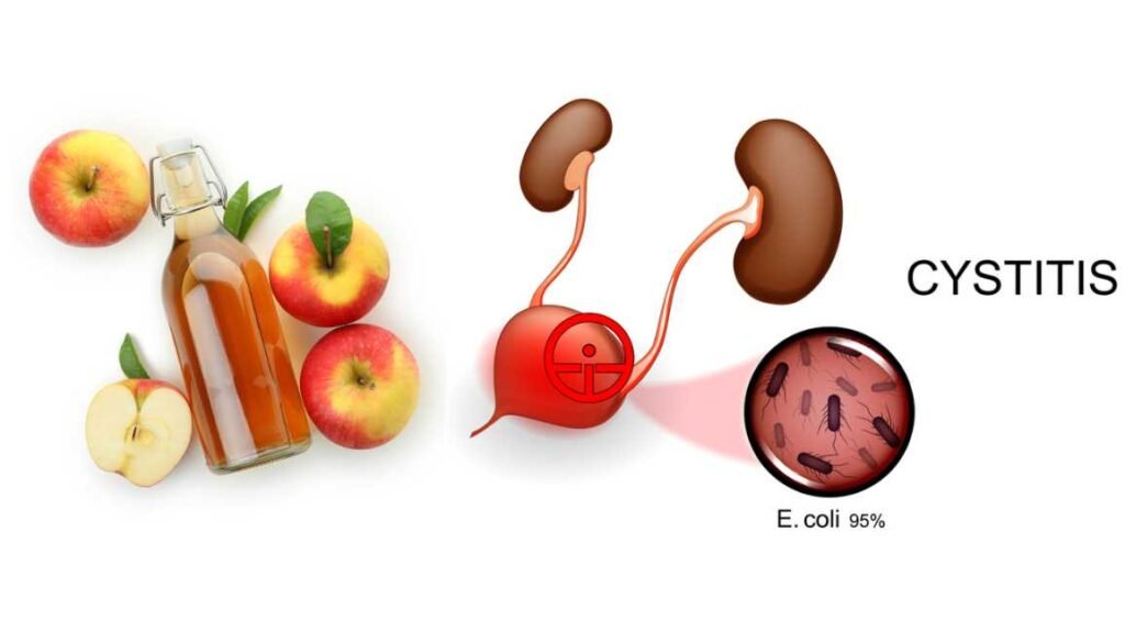 Can Apple Cider Vinegar Cause Cystitis